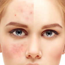 Rodan + Fields to Showcase Teen Acne Treatment Research at AAD